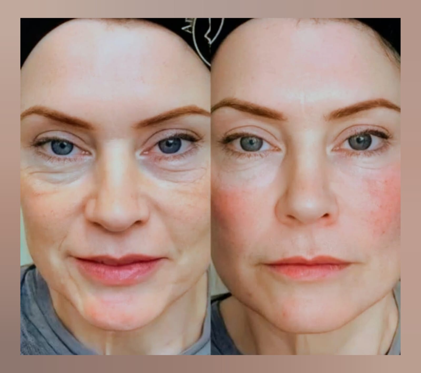 PARCHES CON MICROAGUJAS DE PRECISIÓN PROFUNDA